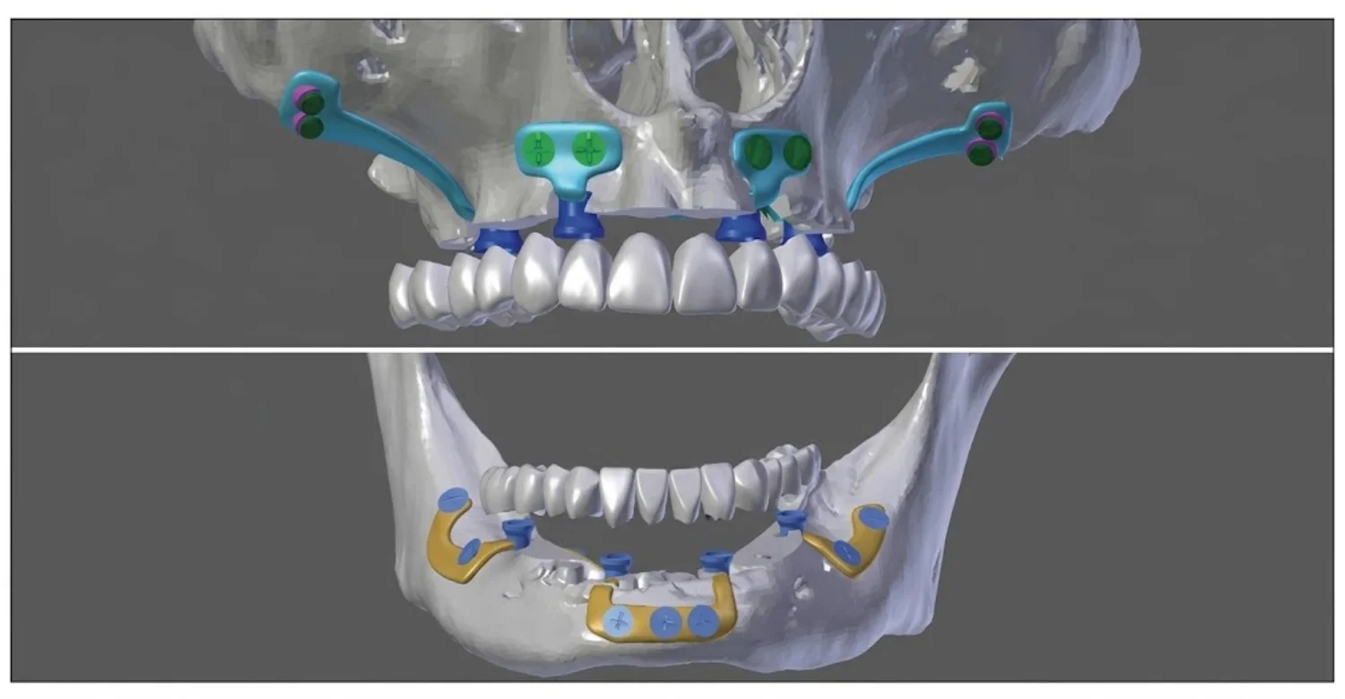 Coupling Element Design in Custom Subperiosteal Implants 2